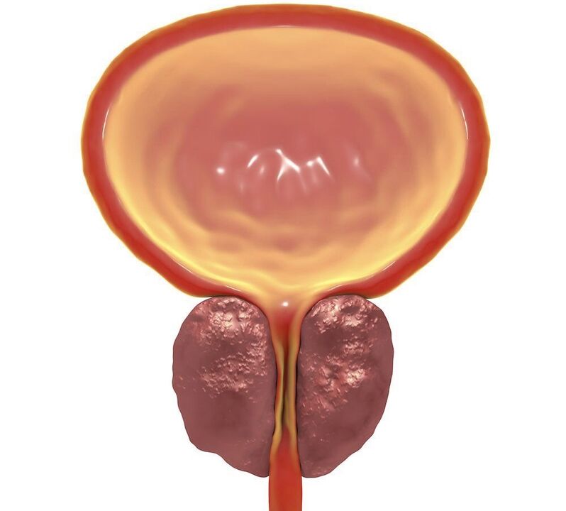 inflamação da prostatite crônica