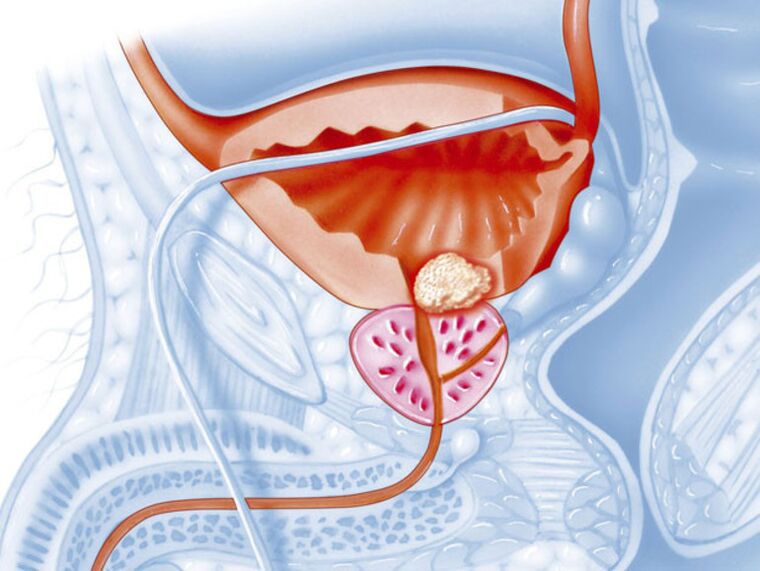 sintomas de prostatite crônica